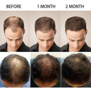 Anti Hair Loss Serum Ginger And Tocopherol Hair Growth Essence Oil Hair Care Serum