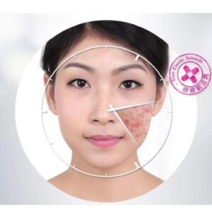 Bioaqua Anti Acne Cream Acne Scar Removal Cream 30g